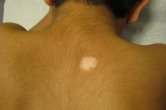 • Location – Back
• Primary lesion – PATCH (flat, non-palpable, >1cm)
• Color – Depigmented
• Secondary change – None