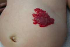 • Location – Abdomen
• Primary lesion – PLAQUE (elevated, palpable, >1cm) or nodule (palpable, >1cm, rounded)
• Color – Dark red
• Shape – Irregular, geographic
• Other descriptors – Lobulated