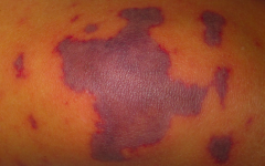 • Primary lesion – PURPURA (area of hemorrhage, flat or elevated)
• Color – Dark purple
• Configuration – Clustered
• Shape – Stellate