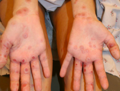 • Location – Palms
• Primary lesion – PAPULES (elevated, palpable, <1cm) and PLAQUES (elevated, palpable, >1cm)
• Configuration? – TARGETOID (bulls-eye)
• Color – Dusky red
• Distribution – ACRAL (distal limbs)
• Seconda...