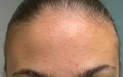 • Location – Forehead
• Primary lesion – Papules
• Size – 1 mm
• Color – Skin-colored, light pink