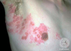 • Location – Chest
• Primary lesion – PAPULES (elevated, >1cm) and
VESICLES (fluid-filled, <1cm)
• Color – Bright pink
• Distribution – Clustered, Dermatomal