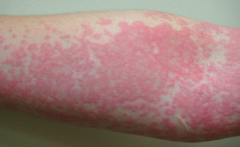 • Location – Arm
• Primary lesion – WHEALS (edematous papules and plaques - characteristic of hives)
• Color – Bright pink, lavender center 
• Number – Innumerable, coalescing
