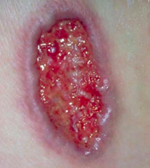 • Primary lesion – Ulcer (open area w/ loss of part of dermis)
• Shape – Irregularly oval
• Border characteristics – Violet-pink, Well-demarcated, Undermined
• Base characteristics – Moist, Red and yellow