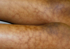 • Location – Legs
• Primary lesion – PATCH (non-palpable, >1cm)
• Configuration – RETICULATED (net-like)
• Color – Brown