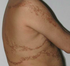 • Location – Arm, chest, abdomen, back 
• Primary lesion – MACULES (flat, <1cm), PATCHES (elevated, >1cm)
• Color – Tan-brown
• Configuration – Linear
• Distribution – BLASCHKOID