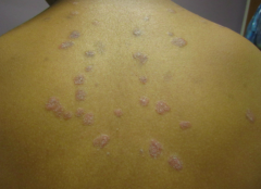 • Location – Back
• Primary lesion – PAPULES (elevated, <1cm), PLAQUES (elevated, >1cm)
• Configuration – Round (guttate)
• Secondary change – Scale