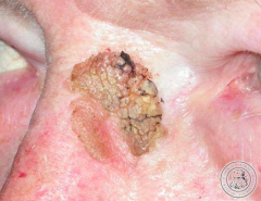 How would you describe this lesion?