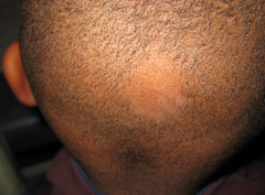 - Smooth patches of complete alopecia (hair loss)
- Nail pits (indentations in nail plate), rough texture, or brittle nature
- Unpredictable course
- Can progress to alopecia totalis (entire scalp) or alopecia universalis (entire body)
- Spont...