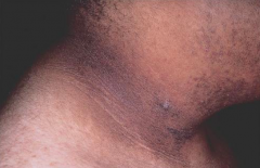 Acanthosis Nigricans - velvety hyperpigmented thickening of skin; commonly in skin folds of posterior neck, axillae, and groin