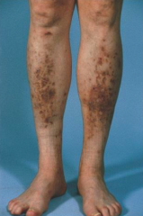 - Brown, atrophic macules and plaques on shins
- Trauma may play a role in pathogenesis
- Marker of poor diabetes control
- 30% of those w/ long-standing diabetes