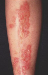 - Yellow-orange, atrophic patches / plaques on shins of diabetic patients
- Multiple, bilateral lesions
- Progressively expand and may lead to ulceration (especially males)
- Not always in DM patients (11-65%)