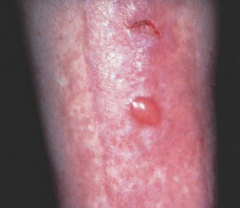 What are the blisters that occur in people with diabetes? Where do they appear?