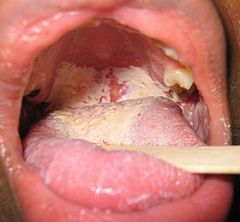 oral candidiasis

oropharyngeal candidiasis is a local infection of:
- older adults who wear dentures
- patients treated with antibiotics, steroids (puffers), chemotherapy, or radiation therapy to the head and neck, - pts w/ cellular immune de...