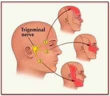 what is trigeminal neuralgia?