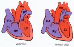 VSD (membranous)


patent foramen ovale


PDA


 


(or create shunt via septostomy or fix w arterial-switch operation)