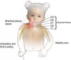 what position is a babies arm in with a brachial plexus injury?