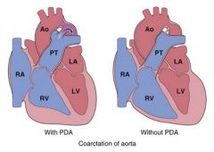 coarctation of the aorta w/ PDA (infantile)