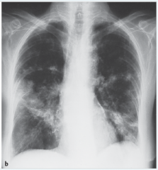 - Röntgen-Thorax: Bild entspricht der Miliar-Tbc
- Erregernachweis in der Lungenbiopsie
- bei ZNS-Befall Liquorpunktion (Eiweiß massiv erhöht)
- Antigennachweis (ELISA)