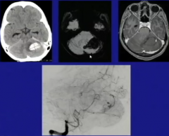 Other Causes Spot Sign
- Aneurysm
<<<AVM