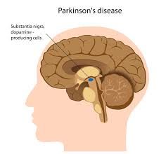 what is the pathology of Parkinsons?