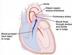what is patent ductus arteriosus ?