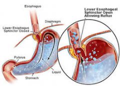 what is gastroesophageal reflux?