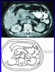 What do you see? Pancreatic mass center left.