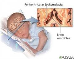 what is periventricular leukomalacia?