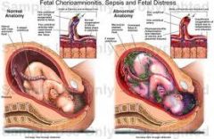 what is chorioamnionitis?