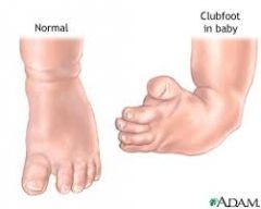 what is talipes equinovarus


 


aka: clubfoot