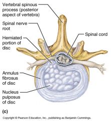 Herniated disks are most common in the lumbar region in the posterolateral direction mostly because the posterior olongitudinal ligament is not broad.  Herinated material will take path of least resistance

Also occurs with cervical  vertebrae