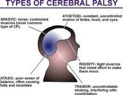 what is the etiology of CP?