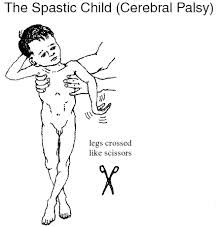what is spastic CP?