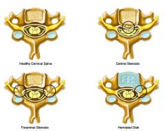 Central stenosis- when the anterior portion of the spinal cord is pressed up against by the posterior aspect of the body of the vertebra

Foraminal Stenosis - when nerves are squished in between intervertebral foramina

Herinated disk - conten...