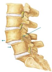 Broken vertebtra caused by trauma or degenerative disease. 

It is a common cause of spondylolisthesis:  anterior displacement of vertebra or vertebral column in relation to the vertebra below.