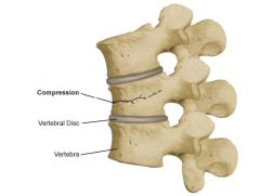 It is a collapse of bone of the vertebral body.  This can be caused by trauma or degenerative disease
