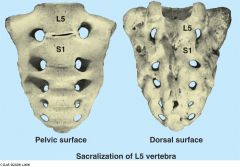 Fusion or partial fusion of L5 to the sacrum.

This would be a congenital defect.