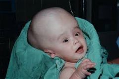 what is hydrocephalus?