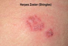 The earliest symptoms of herpes zoster, which include headache, fever, and malaise, are nonspecific, and may result in an incorrect diagnosis. These symptoms are commonly followed by sensations of burning pain, itching, hyperesthesia (oversensitiv...