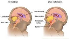 what is arnold chiari malformation?