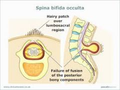 what is spin bifida occulta?