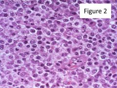 Sheets of monocytoid B cells (fried-egg appearance)
Lymphoepithelial lesions (lymphs embedded in the epithelium)
