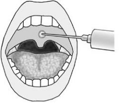 Simple and inexpensive office-based procedure for snoring. 

Involves injecting a sclerosing agent into the midline of the soft palate, using a needle and syringe. 

Agents used include alcohol or sodium tetradecyl sulfate.