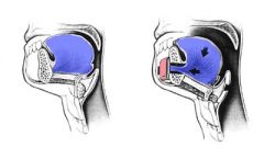 Results in a more anteriorly positioned tongue with increased tension. This helps keep the hypopharyngeal airway patent during sleep when there is muscle atonia. 

Initially described as a horizontal inferior sagittal osteotomy, it was later mod...