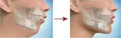 For pt's with retrognathia, mandibular advancement improves not only cosmetic appearance but helps to open the hypopharyngeal airway. 

Performing bilateral sagittal osteotomies at the ramus allows the mandible to be advanced anteriorly and secu...