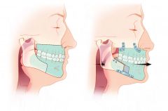 THE most effective surgical procedure for OSAS! (most successful is still trach)

Enlarges the pharyngeal and hypopharyngeal airway by expanding the skeletal framework. The maxilla and mandible are advanced by making osteotomies (LeFort 1 and bi...