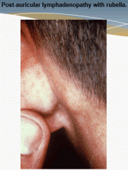 There is a prodromal period 1-5 days before rash that includes fever, eye pain, arthralgia, sore throat and GI complaints. There may also be posterior auricular lymphadenopathy. The maculopapular rash is similar to Measles as it starts on the face...