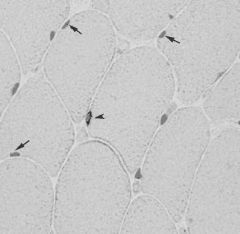 Mature fibers CANNOT undergo mitosis
Satellite cells in the basal lamina, which are normally quiescent cells, mononucleate, and capable of mitosis, differentiate into myoblasts and fuse to form new skeletal muscle fibers.
CD56 stains satellite c...