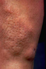 Pretibial Myxedema
- Cutaneous infiltration of skin w/ MUCIN
- Peau d'orange skin - brown/red, firm